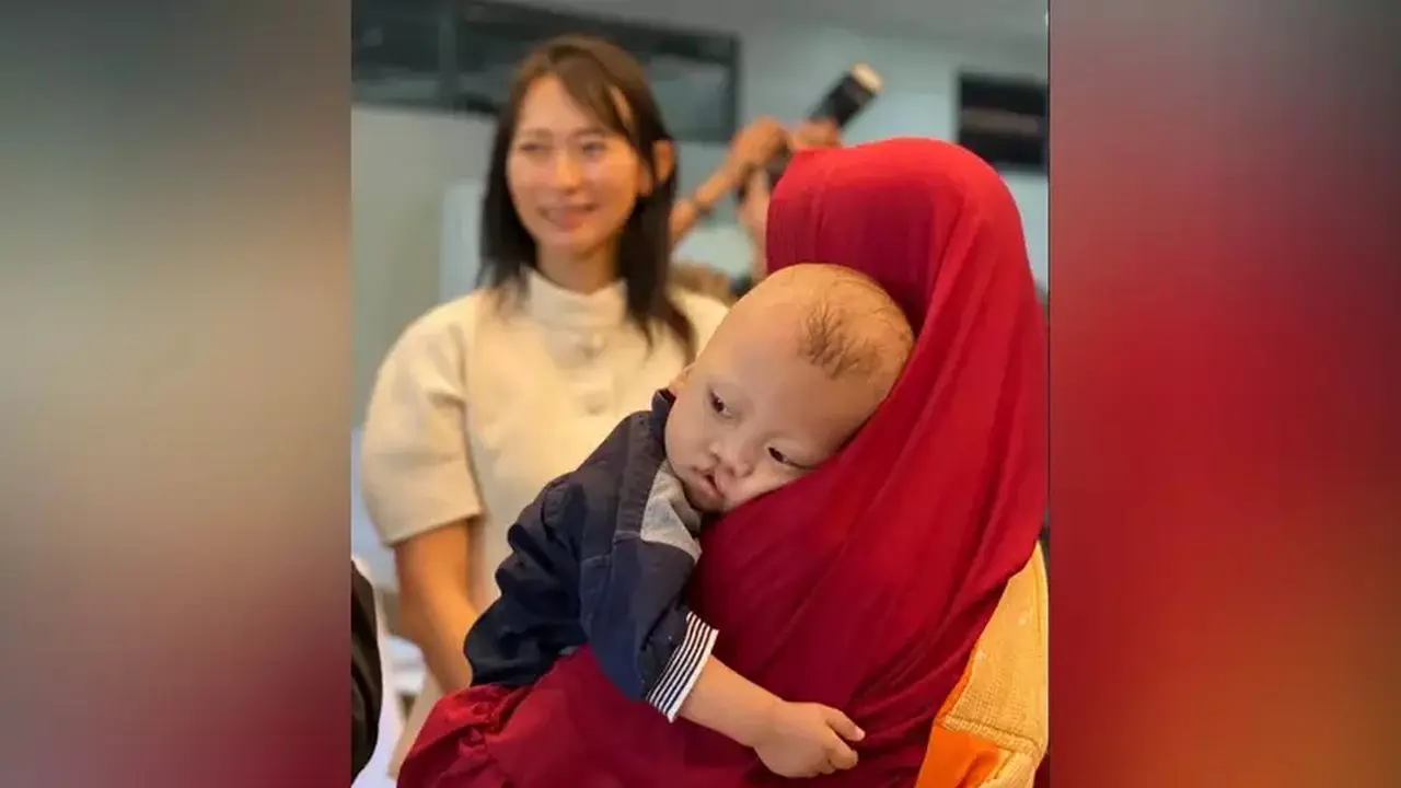 Operasi Bibir Sumbing: Lebih dari Estetika, Kunci Tumbuh Kembang Optimal Anak